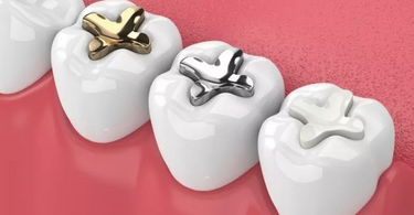 Are Metal-Free Fillings Better Than Traditional Silver Fillings?