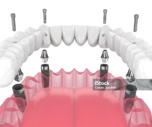 Restore Your Smile with Dental Implants in Dubai – Why Pearl Dental Clinics is Your Top Choice