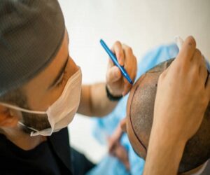 Will I need a second hair transplant in the future?