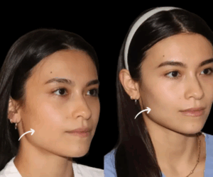 Best Plastic Surgeons in Dubai for Facelifts with Sculptra Fillers