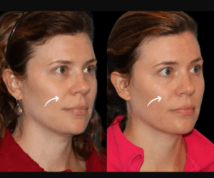 Best Doctors in Dubai Offering Sculptra Fillers