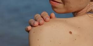 Sunshine Coast Skin Cancer Centre (formerly Skin Surveillance)