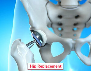 Hip Replacement Surgery in India: A Life-Changing Procedure for Pain Relief and Mobility