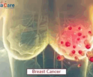 Comprehensive Guide to Breast Cancer Treatment in India – Procedures, Cost & Recovery
