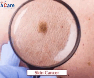 Skin Cancer Treatment in India: Types, Costs, and Top Hospitals