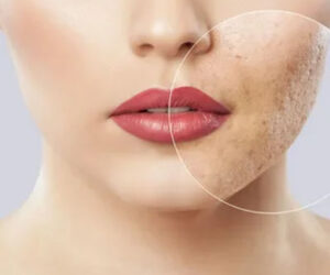 What to Do Before and After Acne Scar Treatment in Islamabad