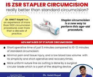 Laser Treatment for Kidney Stones: Is It Right for You?