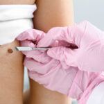 Cryotherapy for Moles Pros and Cons