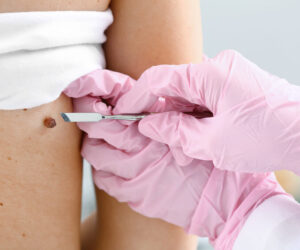 Cryotherapy for Moles: Pros and Cons