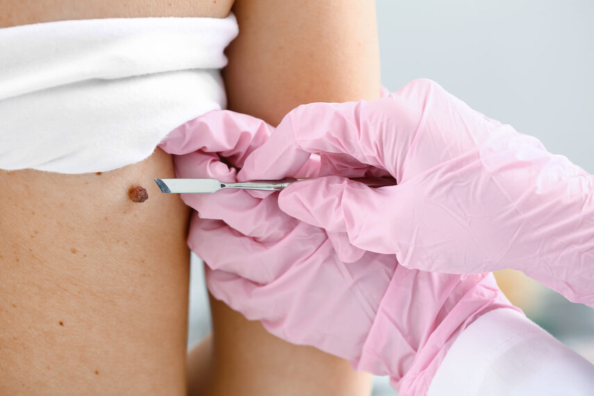 Cryotherapy for Moles Pros and Cons