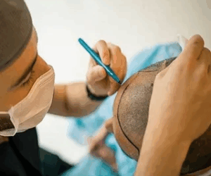 How Many Sessions Are Needed for a Full Hair Transplant in Islamabad?