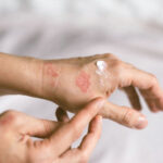 Is It Contagious Debunking Myths About Skin Conditions