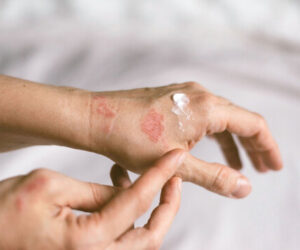 Is It Contagious? Debunking Myths About Skin Conditions