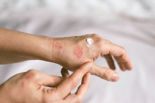 Is It Contagious Debunking Myths About Skin Conditions