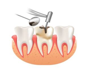 Root Canal in San Antonio, TX: Expert Care for Tooth Pain Relief