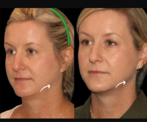 What Makes a Best Plastic Surgeon in Dubai Truly “World-Class” in Sculptra Fillers Expertise?