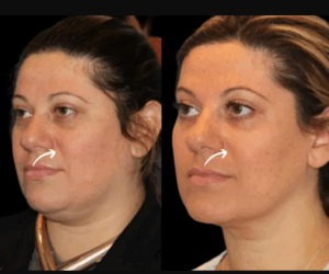 Dubai’s Best Doctors Educating the Public on Sculptra Fillers Benefits and Risks