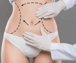 The Psychological Benefits of Tummy Tuck Surgery in Islamabad