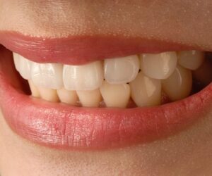 Cosmetic Dentistry for Influencers: Why Your Smile Is Your Brand