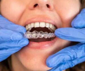 Is It Possible to Straighten Teeth at Any Age?