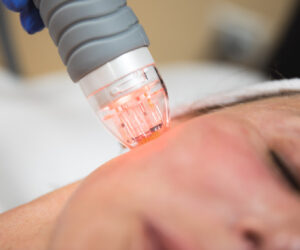 How Fractional RF Microneedling Improves Skin Texture