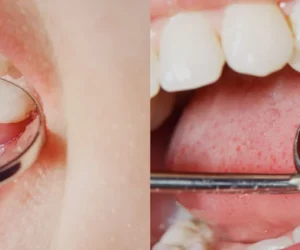 Get a Natural Smile Makeover with Advanced Dental Fillings in Ahmedabad