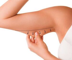 Arm Lift Surgery Abu Dhabi | Expert Brachioplasty for Toned, Youthful Arms