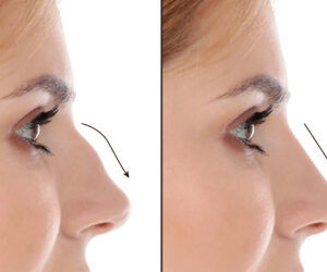 Septoplasty in Dubai: Modern Solutions for Better Breathing