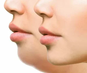Double Chin Treatment for Better Confidence in Islamabad