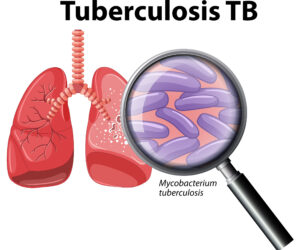 Defeating the Silent Killer: How Tuberculosis is Being Eradicated from the Streets and Ghats of Varanasi in 2025–2030