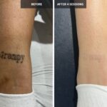 Tattoo Removal in Islamabad