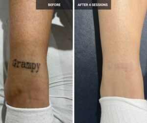 Tattoo Removal With Minimal Side Effects in Islamabad