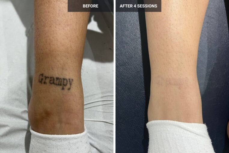 Tattoo Removal in Islamabad