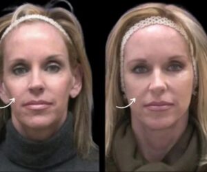 Best Plastic Surgeon in Dubai for Sculptra Volume Balance