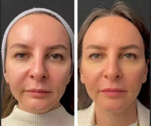 Hair Loss Treatment Using Mesotherapy at the Best Aesthetic Clinic in Dubai