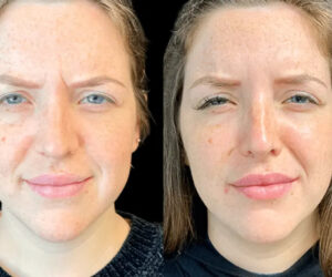 Advanced Botox Techniques Used by the Best Aesthetic Clinic in Dubai