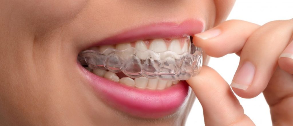 Invisible Braces in Pune